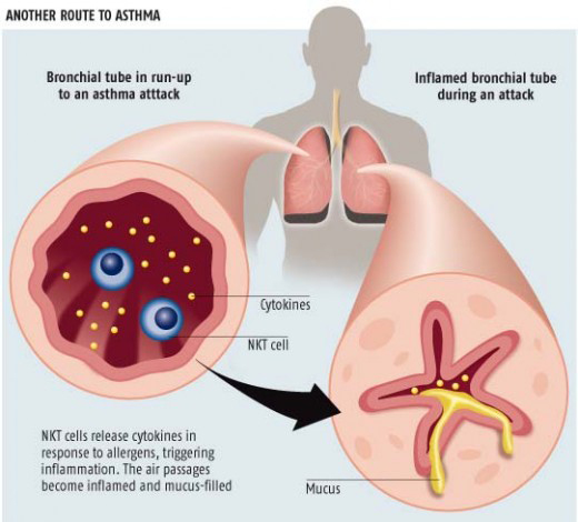BERRY HEALTH: Bronchial Asthma