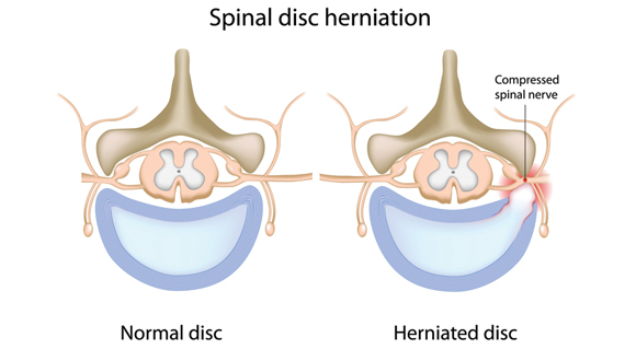 BERRY HEALTH: Myths about Herniated Discs